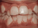 Teeth Crowding before